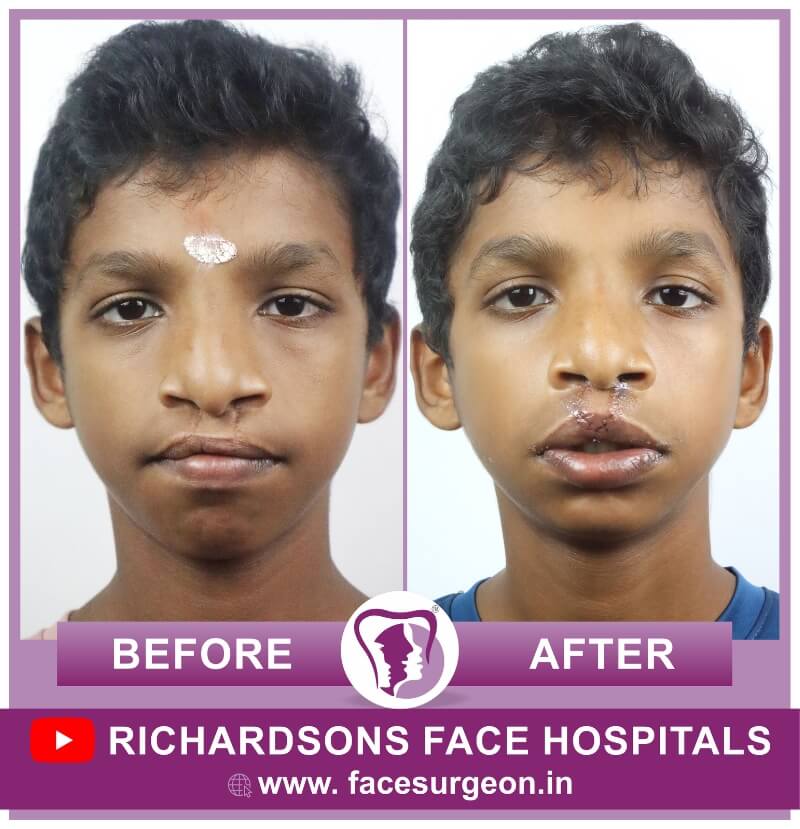 http://Lip%20Revision%20Surgery%20Results