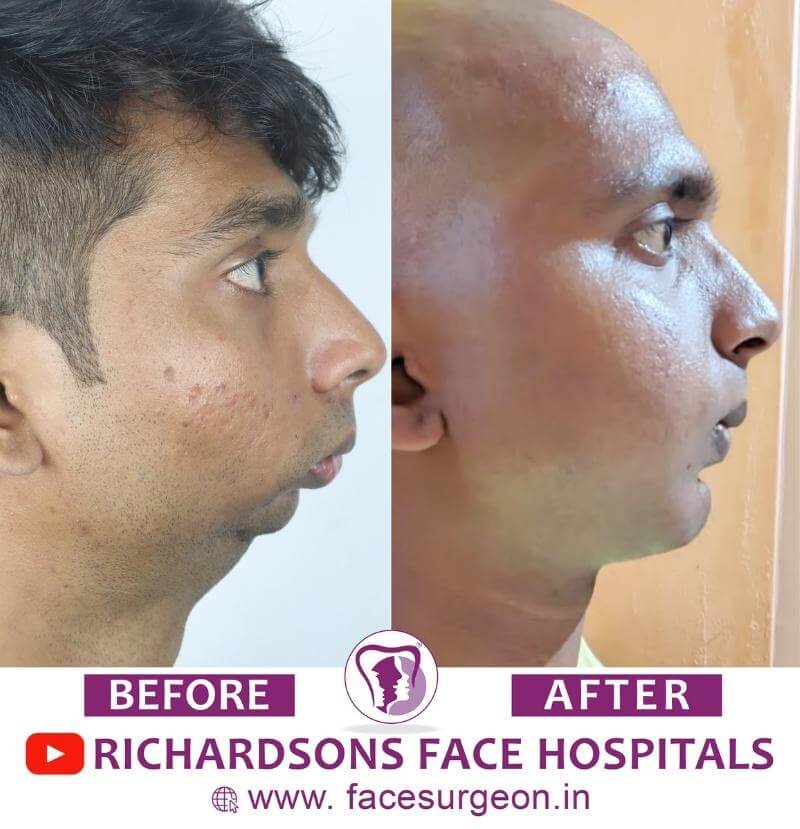 Mentoplasty Before and After Result