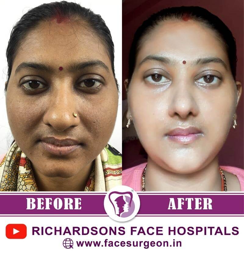 Mentoplasty Before and After Results