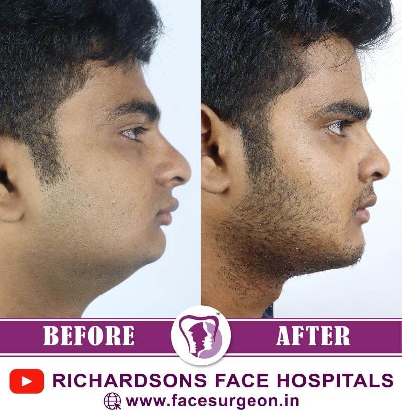 Mentoplasty Before and After