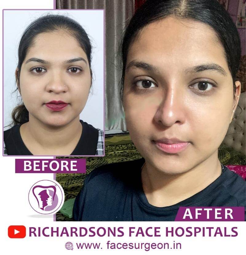 http://Nose%20Reshaping%20Surgery%20Front%20View