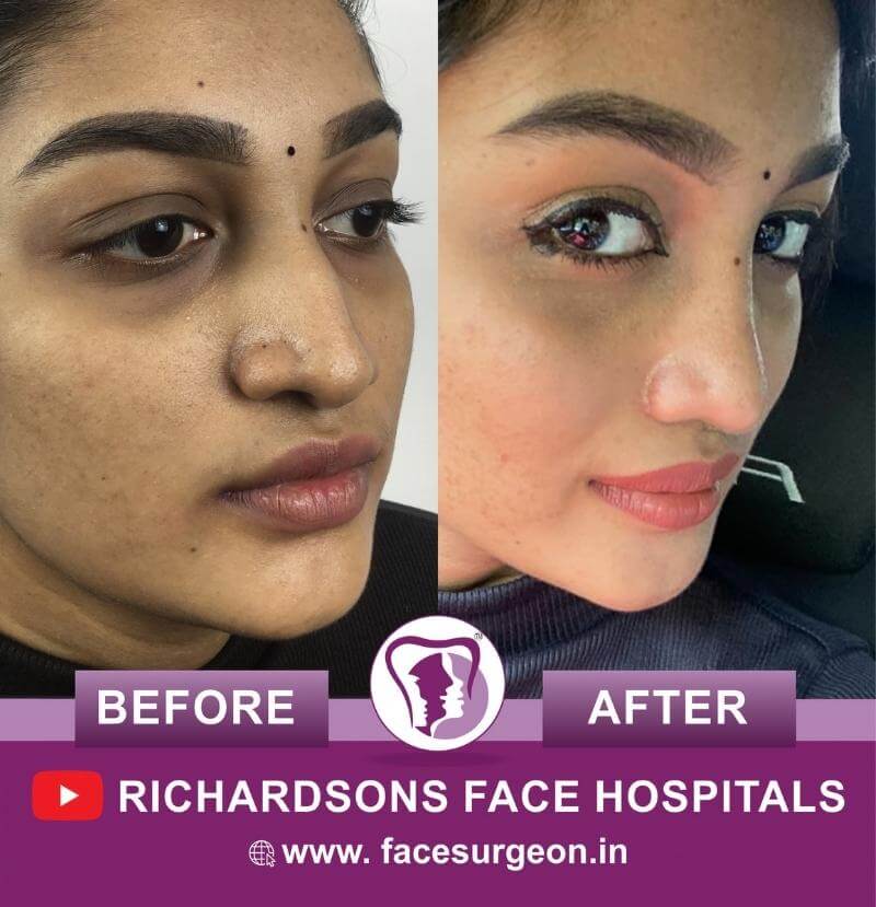 http://Nose%20Reshaping