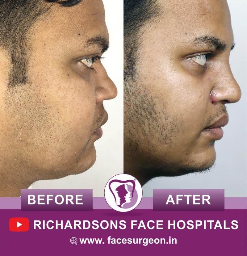 Nose Surgery Before After