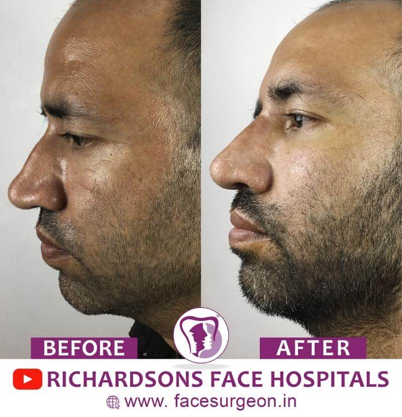 Nose Surgery Before and After