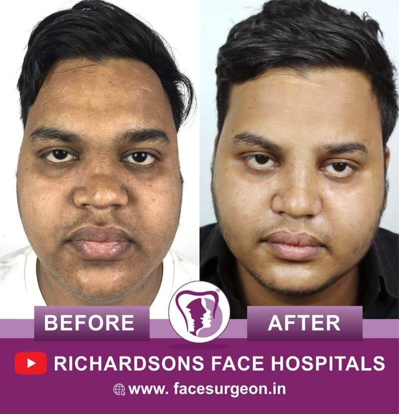 http://Nose%20Surgery%20Front%20View