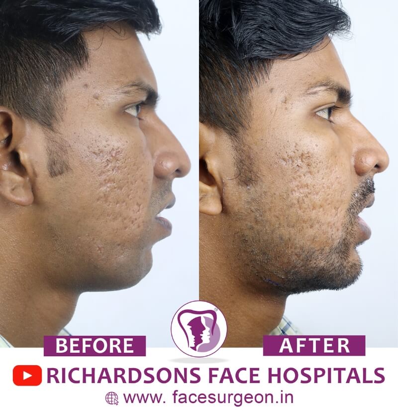 Orthognathic Surgery Before After