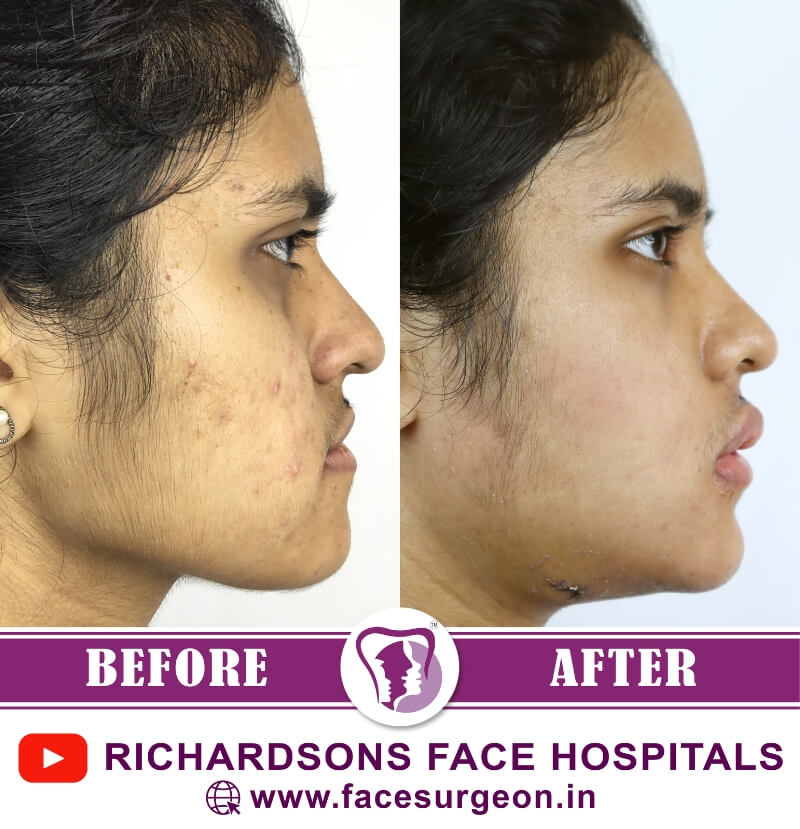 Orthognathic Surgery Results