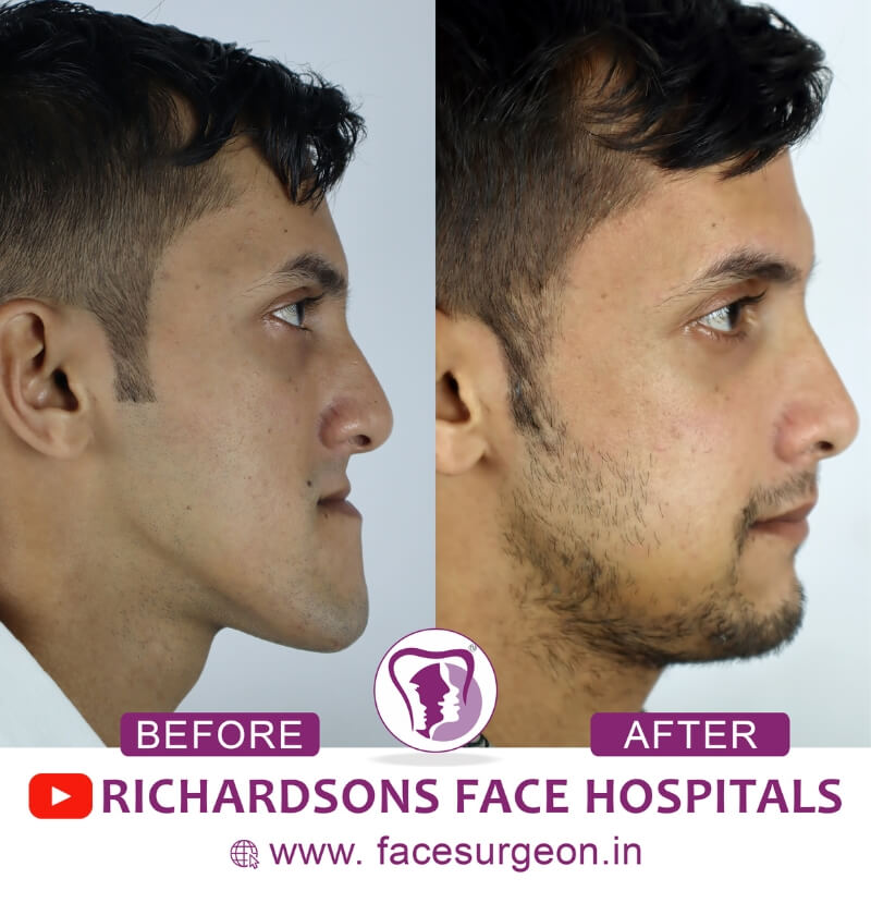 Orthognathic Surgery Side View
