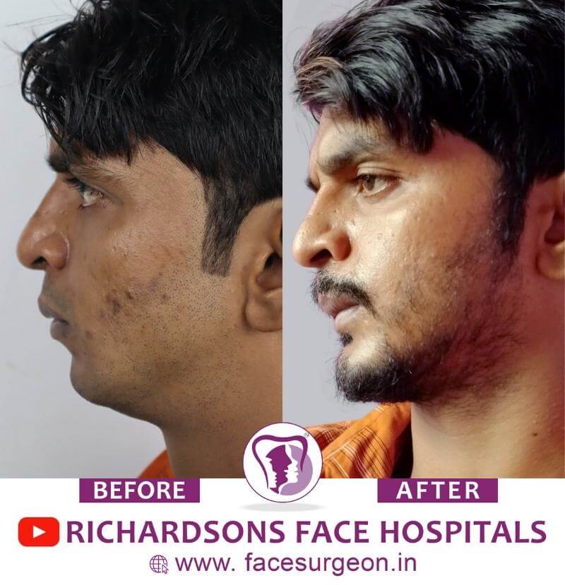 Results of Chin Surgery