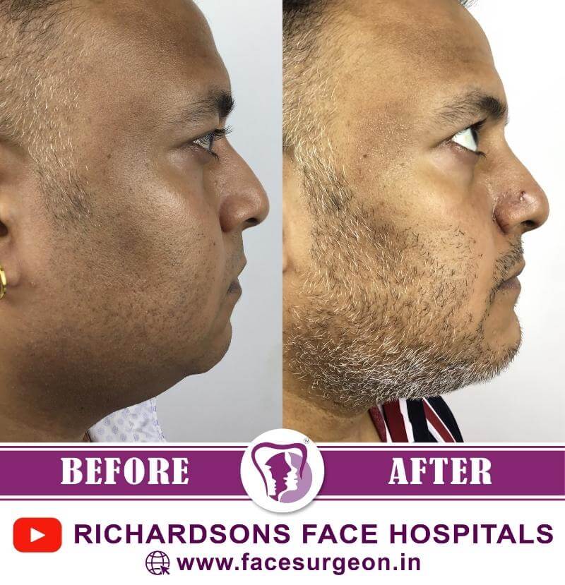 http://Rhinoplasty%20Before%20After