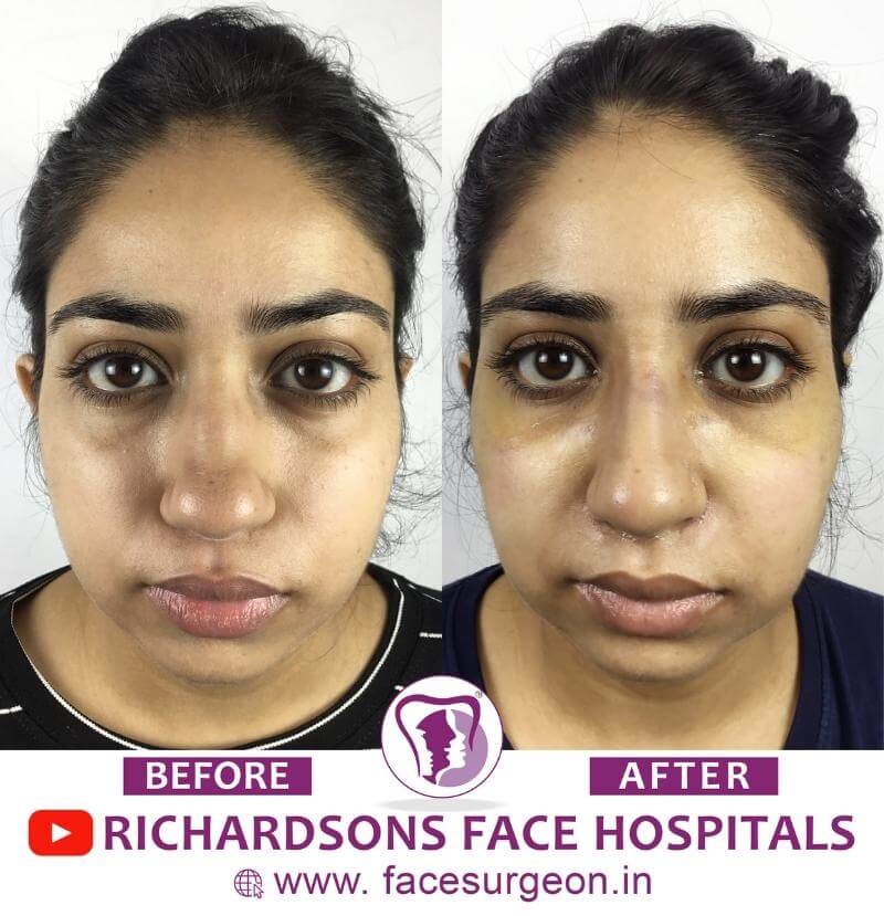 http://Rhinoplasty%20Before%20and%20After