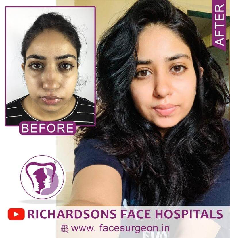 http://Rhinoplasty%20Front%20View