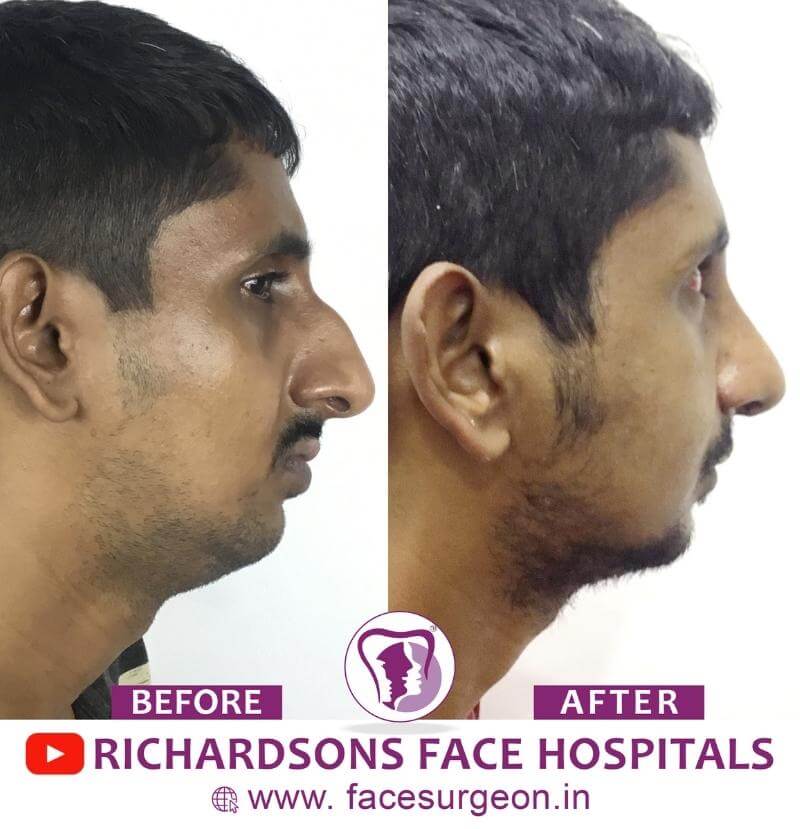 http://Rhinoplasty%20Surgery%20Before%20After
