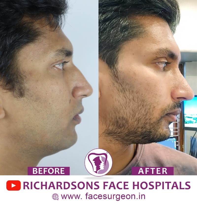 Rhinoplasty Surgery Before and After