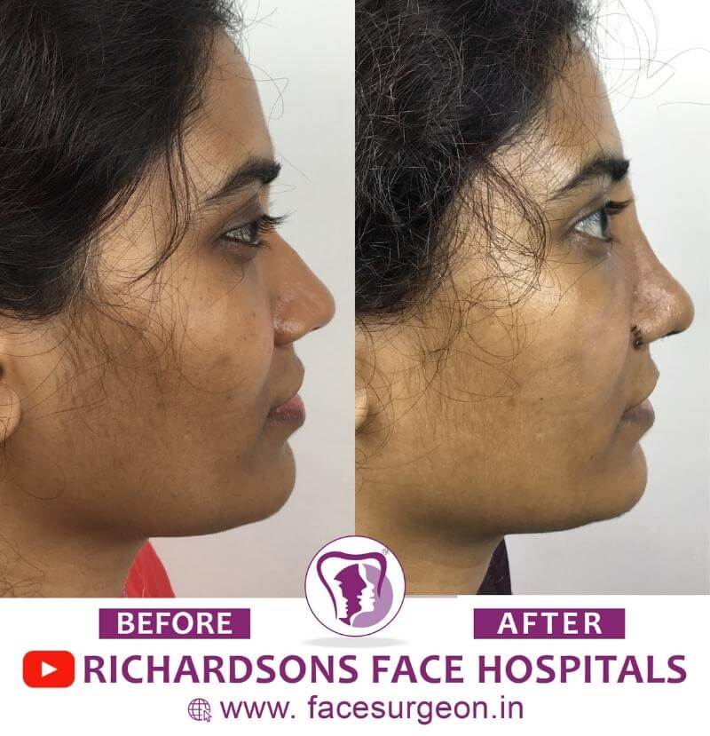 Rhinoplasty Treatment Before and After