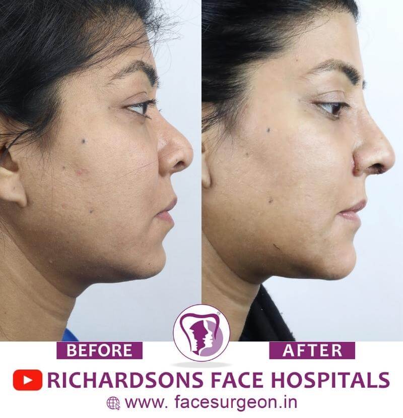 Side View of Nose Reshaping Surgery