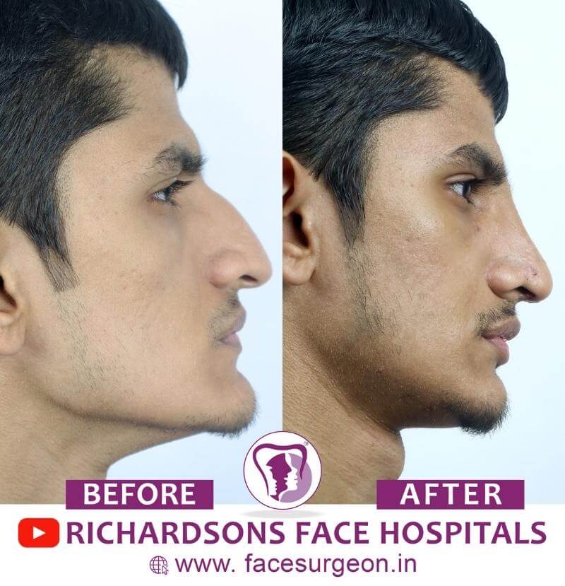 http://Side%20View%20of%20Rhinoplasty%20Surgery