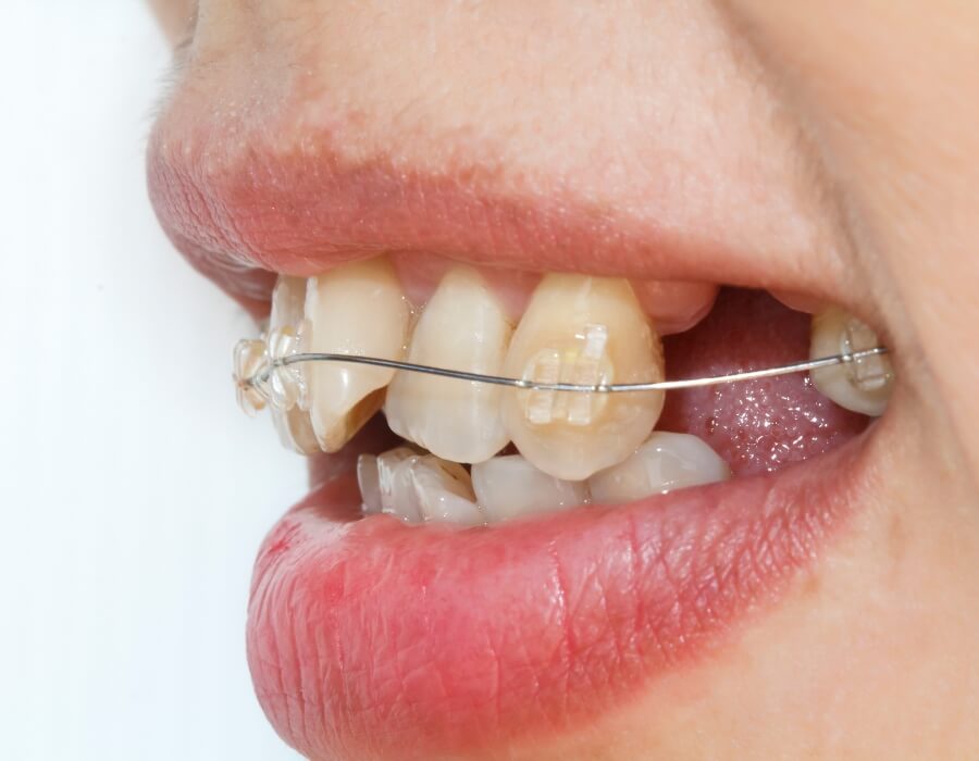 Crooked Teeth treatment