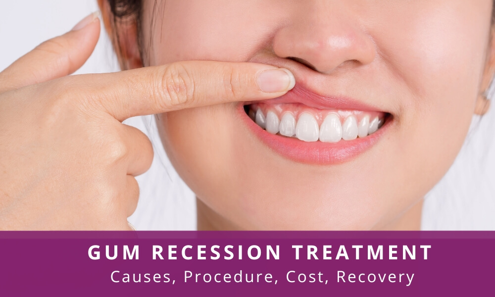 Gum Recession Treatment