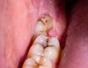 Impacted Teeth Treatment