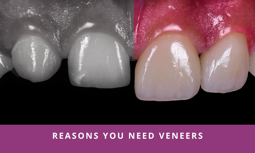 Reasons to need veneers
