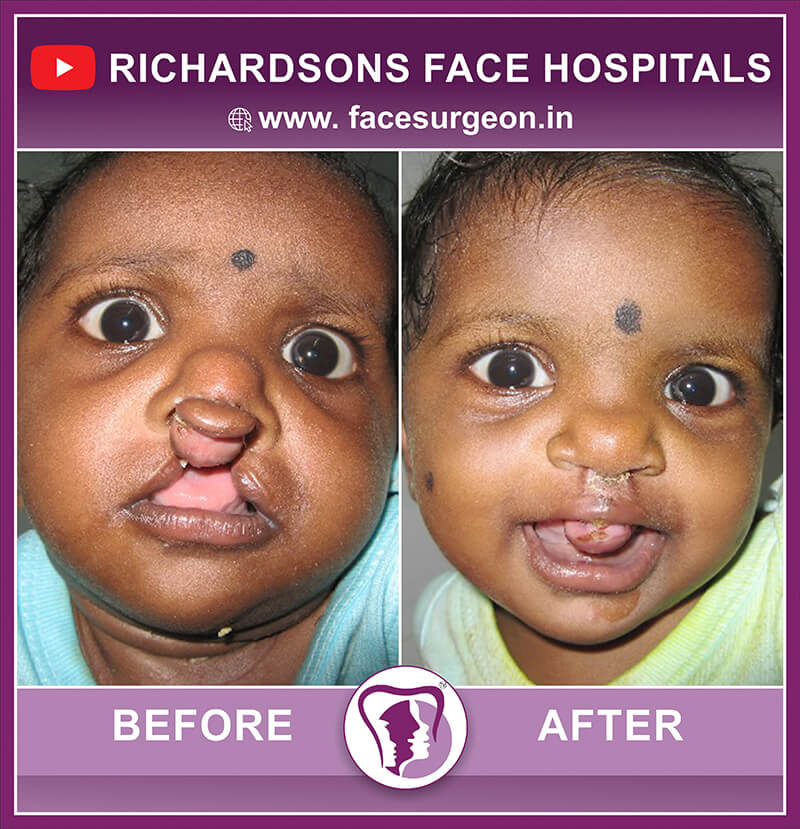 Baby Cleft Lip Surgery Front View