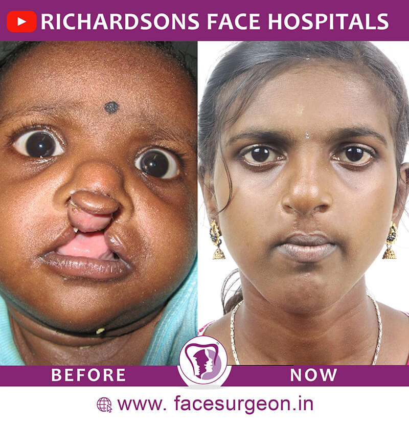Baby Cleft Lip Treatment Before After