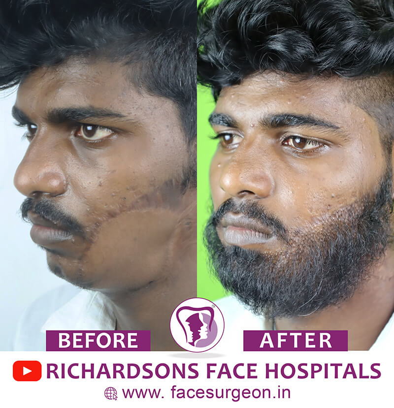 Beard Transplant Surgery Before After