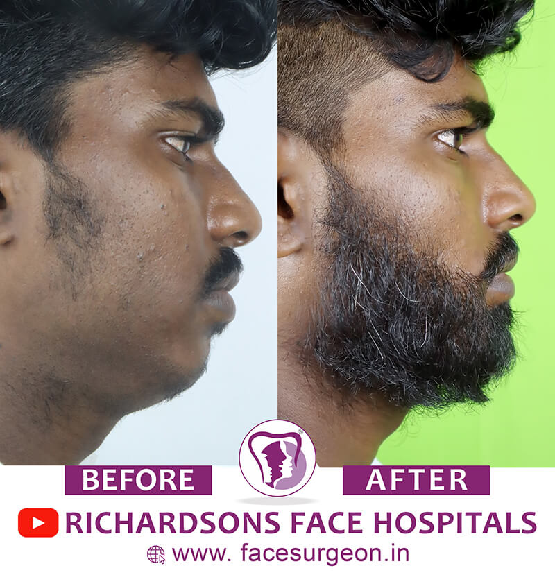 Beard Transplant Surgery Side View
