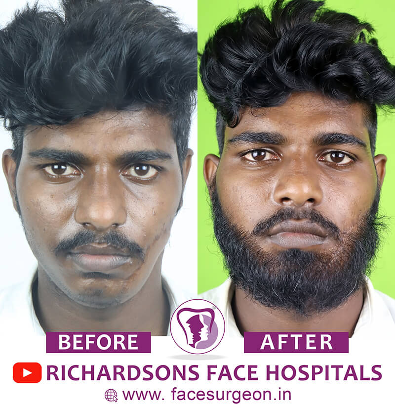 http://Beard%20Transplant%20Surgery