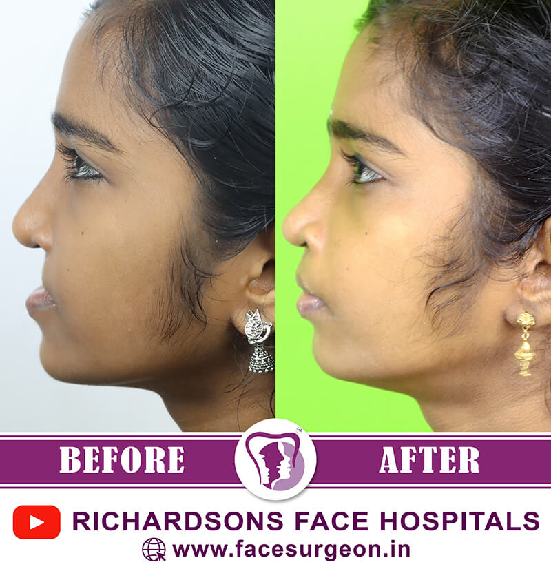 Cleft Lip Surgery Side View