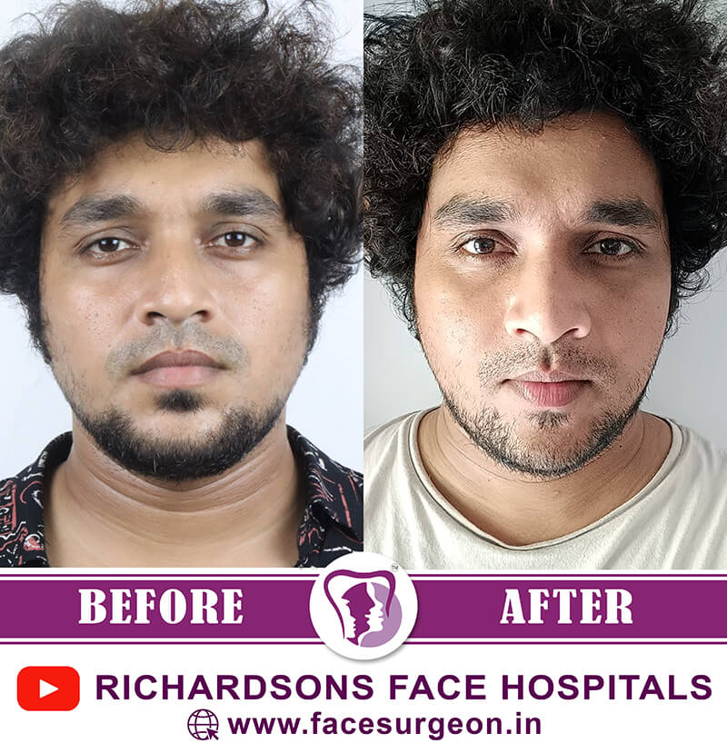Corrective Jaw Surgery