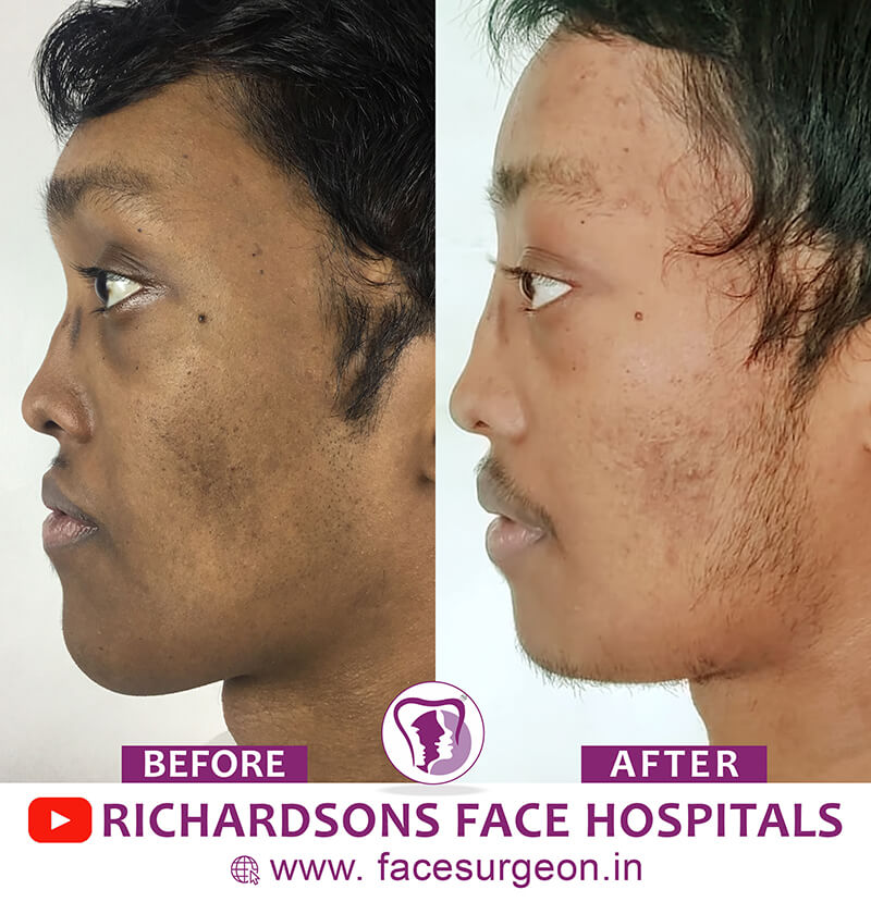 Facial Asymmetry Surgery Results