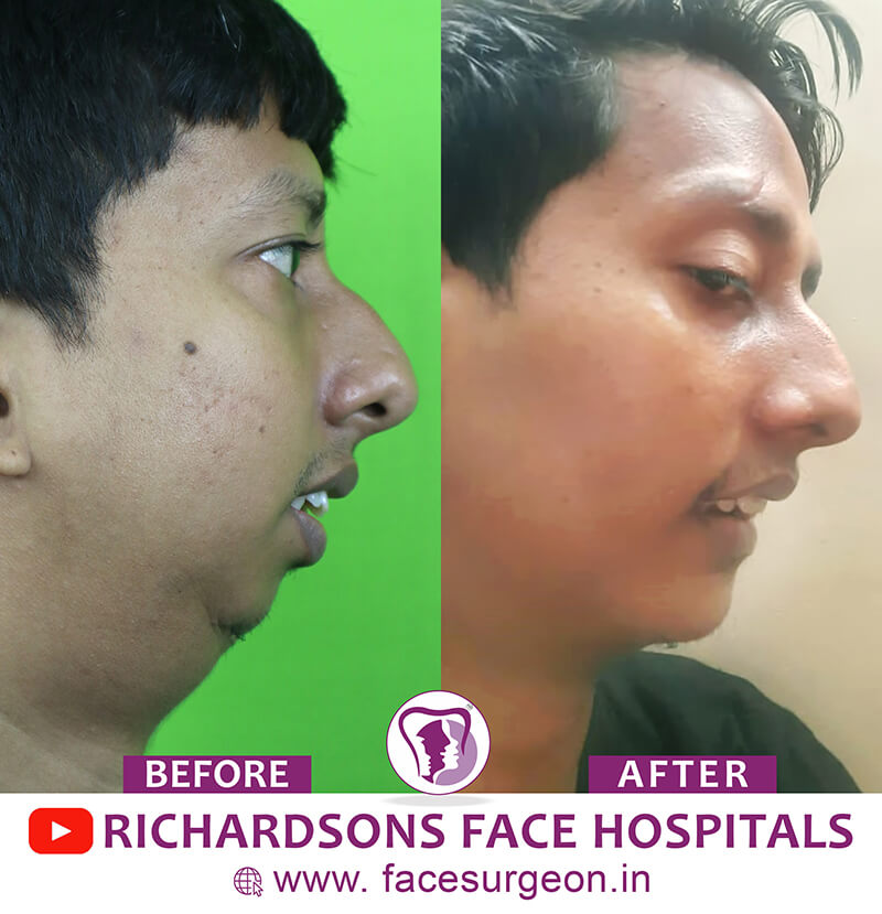 Facial Asymmetry Surgery Side View