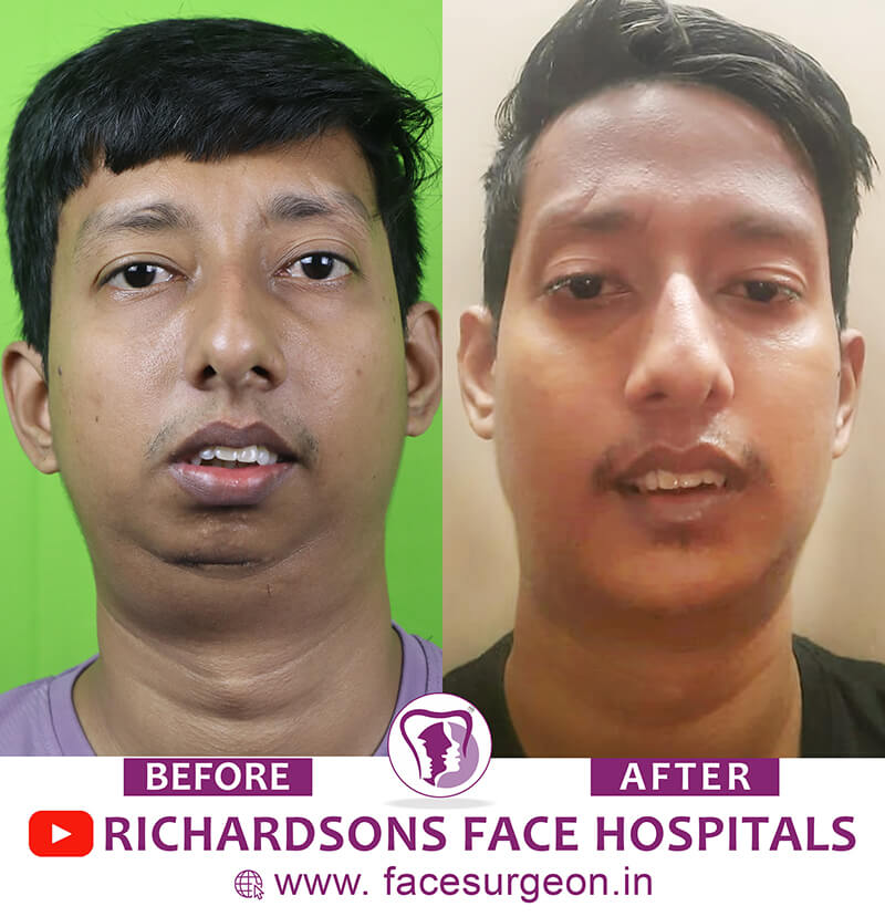 Facial Asymmetry Surgery