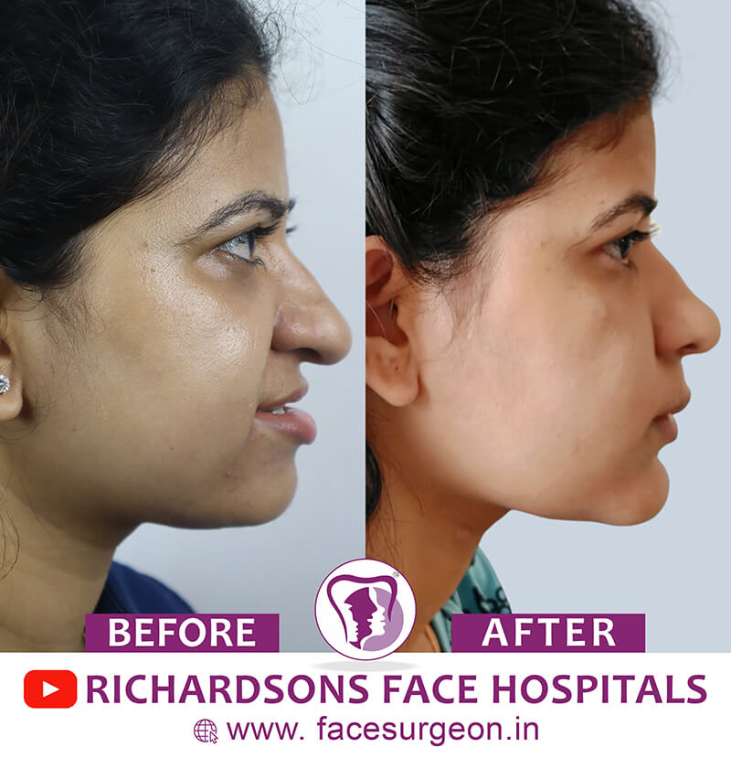 Nose Reshaping Surgery Results