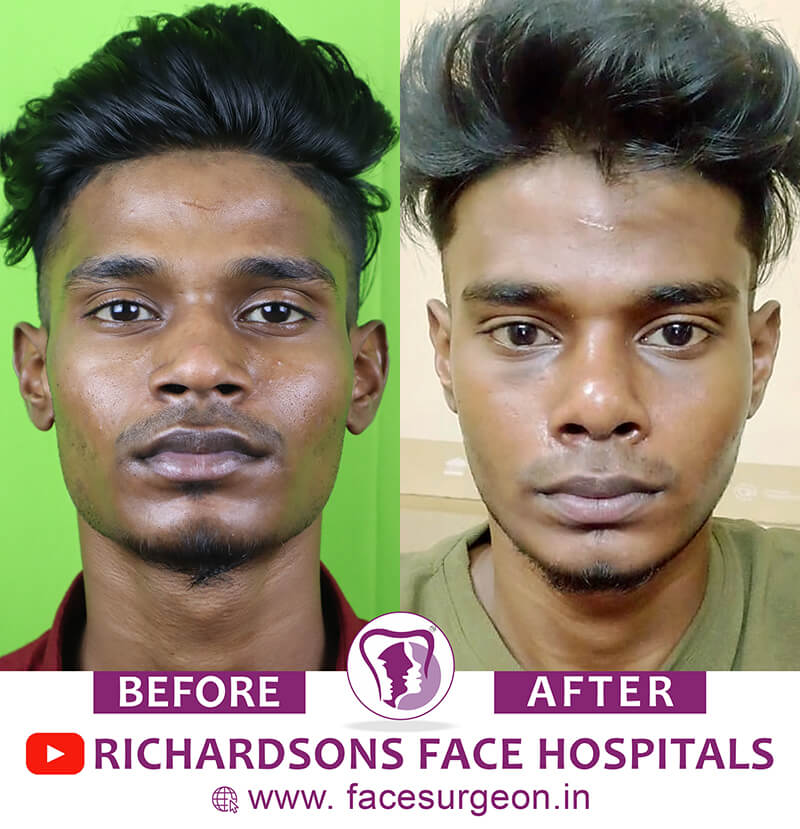 http://Nose%20Reshaping%20Surgery