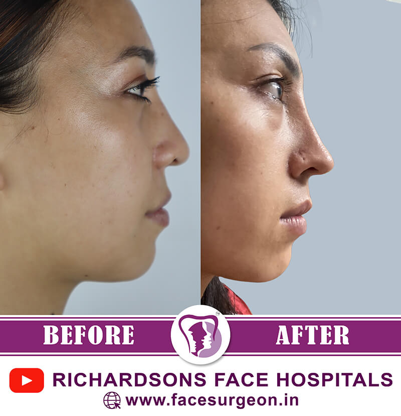Nose Surgery Results