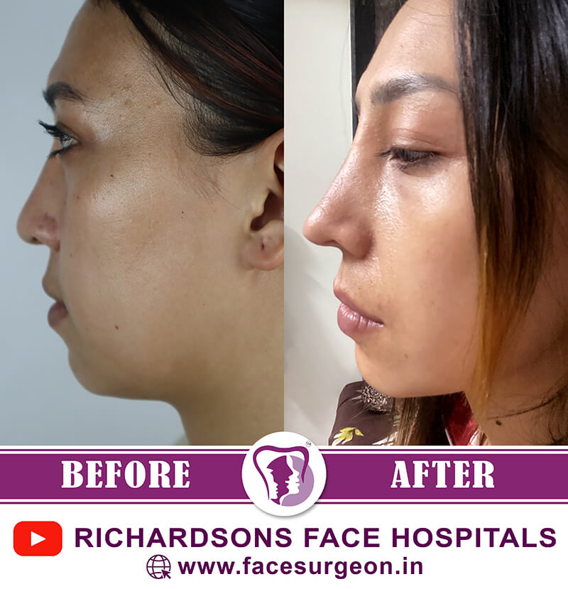 Nose Surgery Treatment