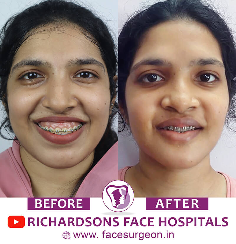 Orthognathic Surgery Results