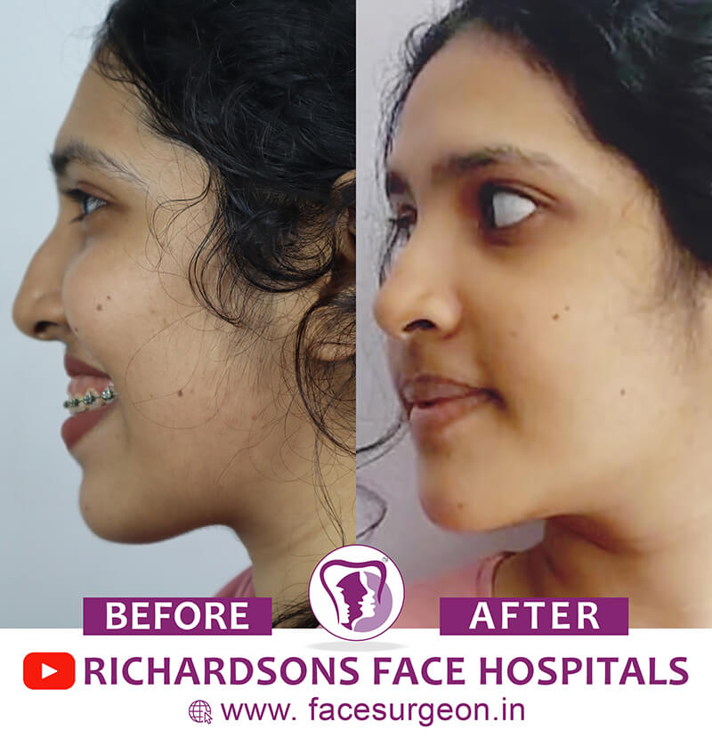Orthognathic Surgery Side View