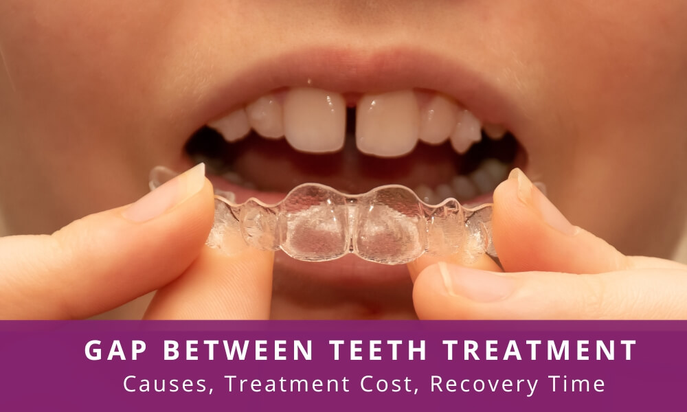 gap between teeth treatment