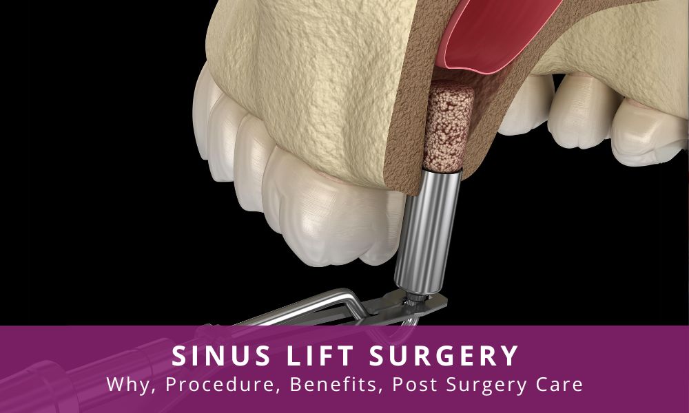 sinus lift surgery india