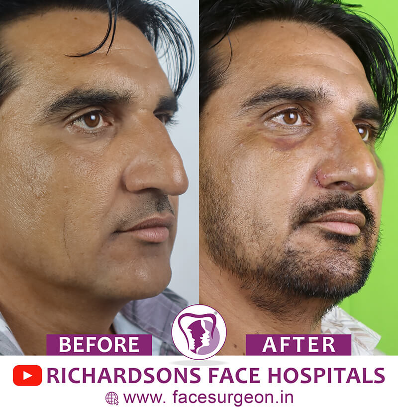http://Nose%20Surgery%20Men%20Before%20After