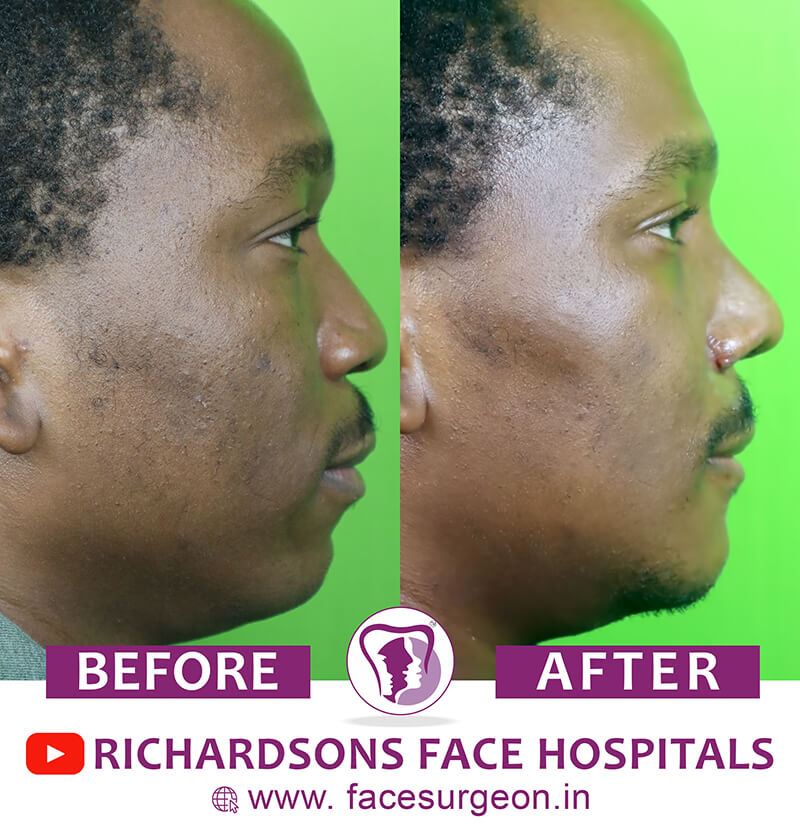 http://Nose%20Surgery%20Men%20Side%20View