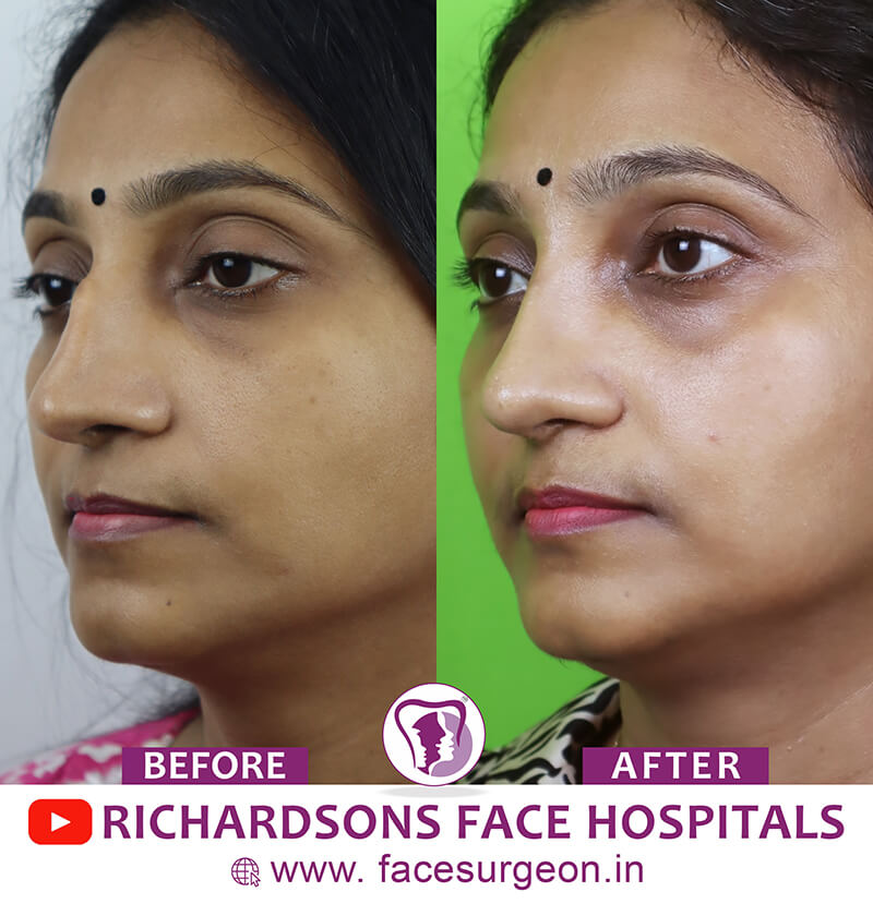 http://Nose%20Surgery%20Right%20side%20view