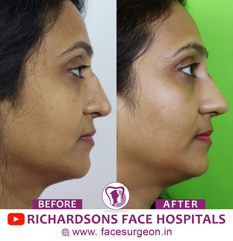 http://Nose%20Surgery%20Side%20view