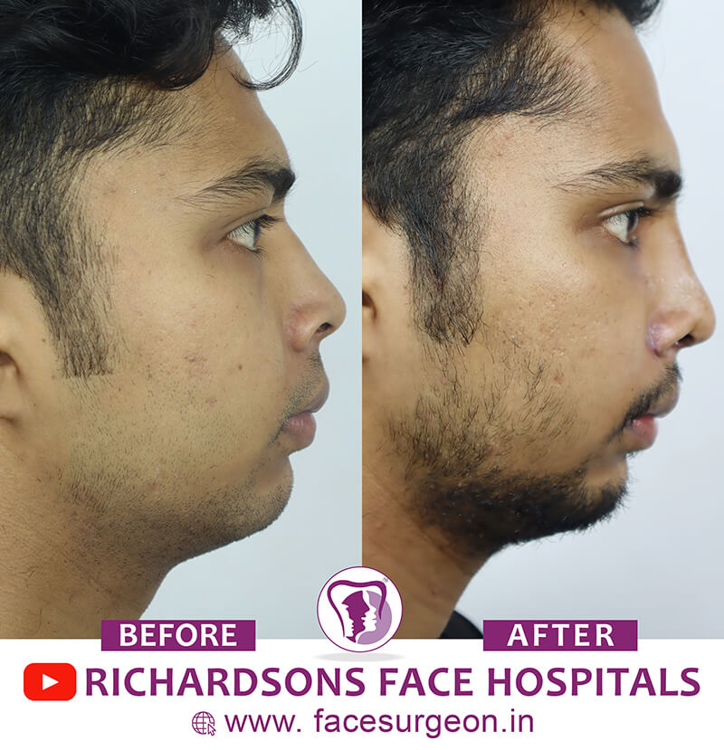 http://Nose%20Surgery%20side%20view