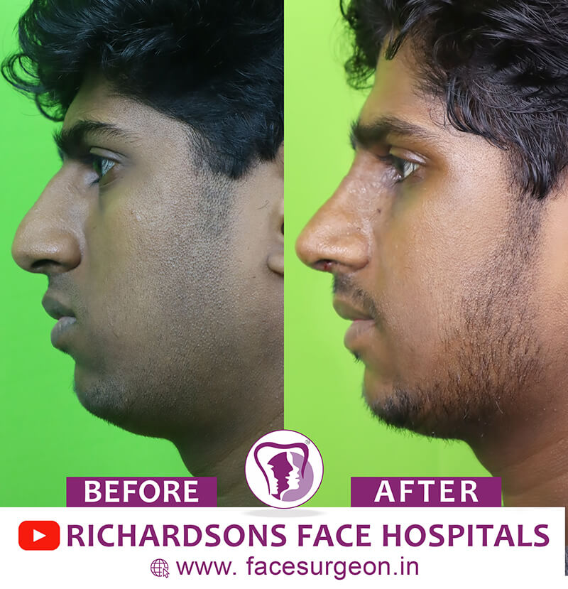 http://Nose%20Surgery%20side%20view%20before%20after