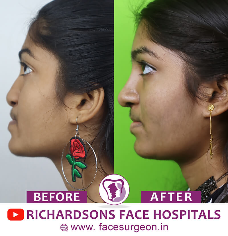 http://Rhinoplasty%20Girl%20Before%20After